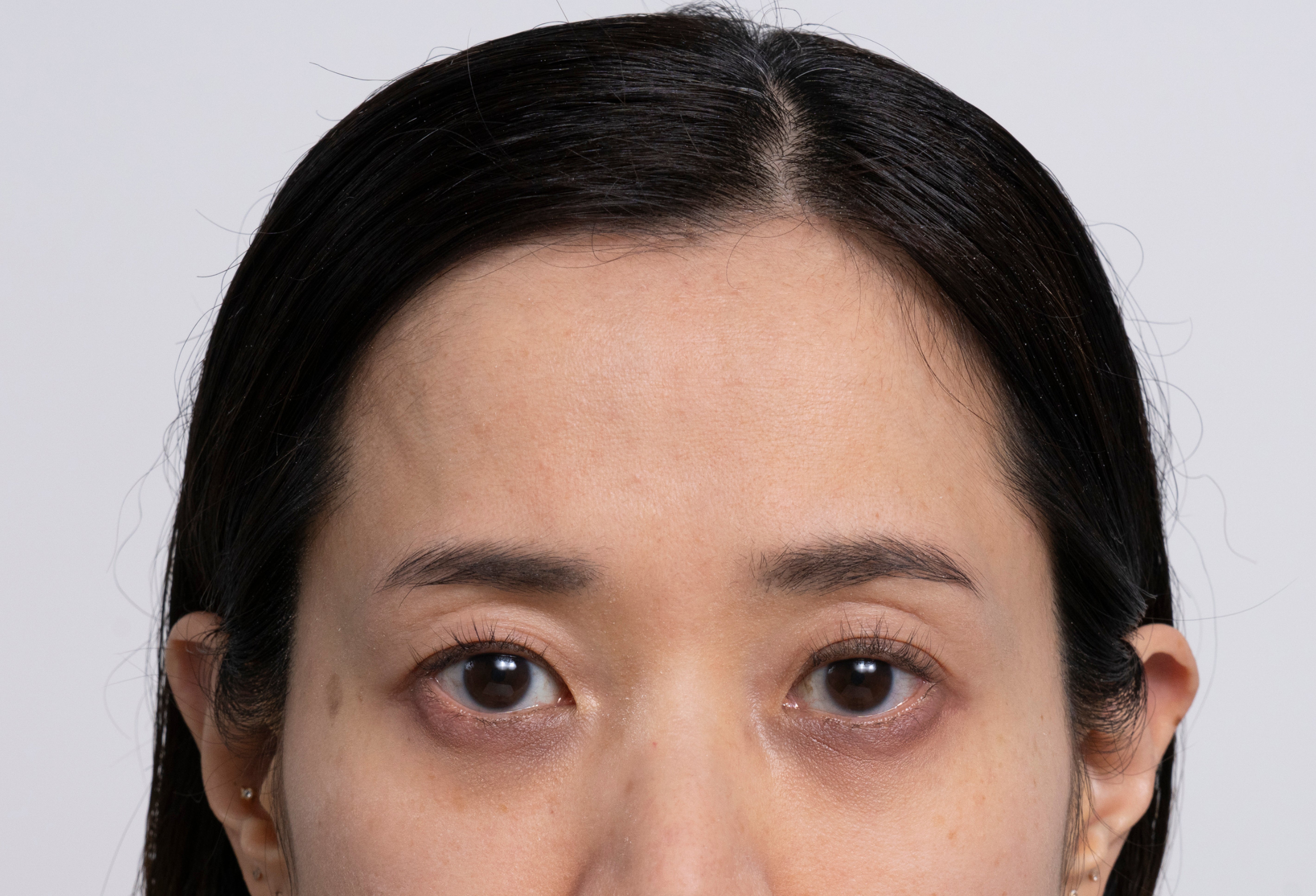 Teilportrait einer Frau mit glatter Stirn, reiner Haut und leichten Augenringen.