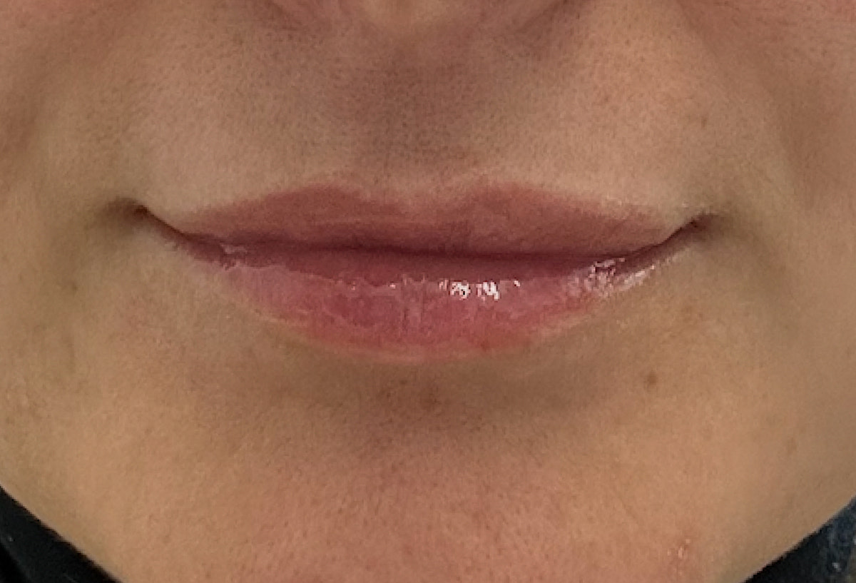 Lip Plumper