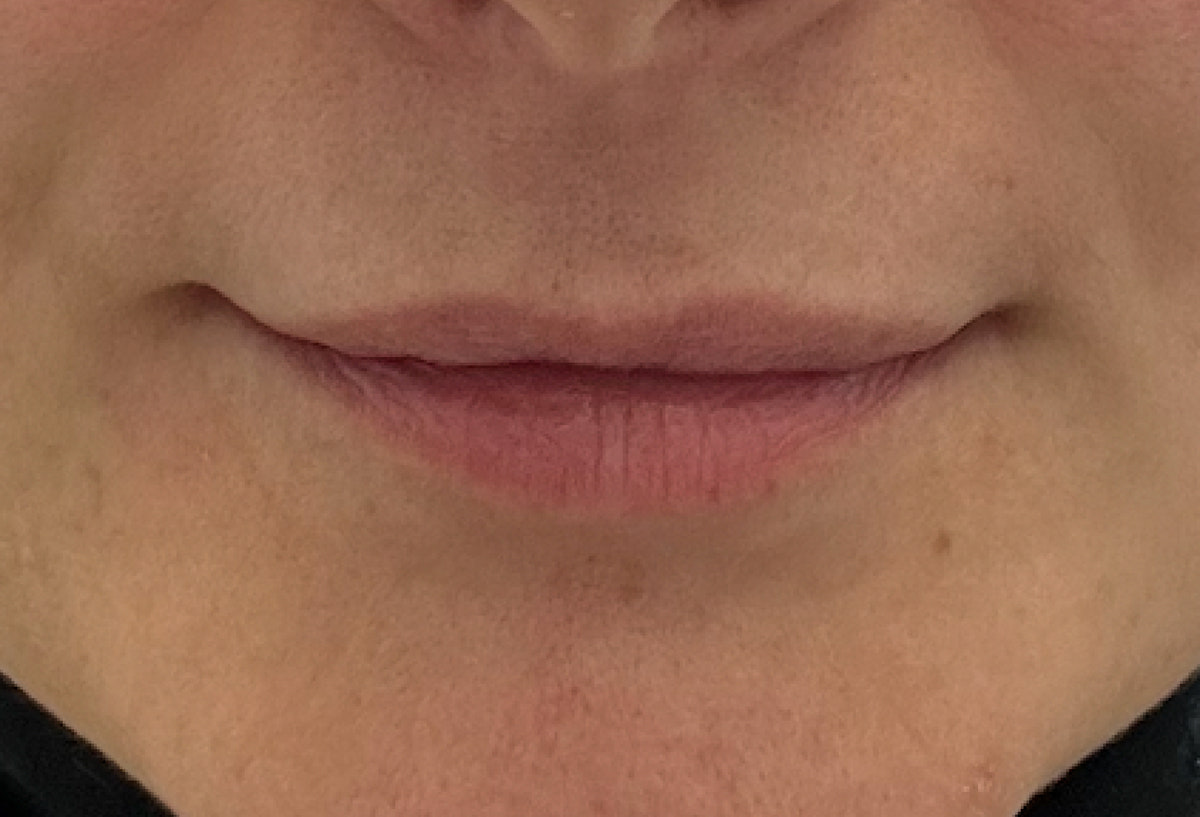 Lip Plumper