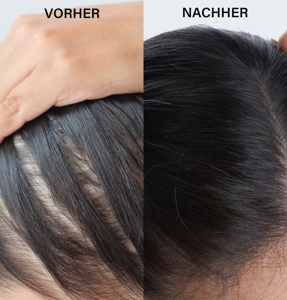 SOS Anti-Hair Loss Set
